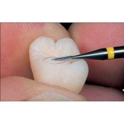 Material dental de calidad